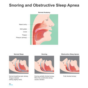 Obstructive Sleep Apnoea (OSA)